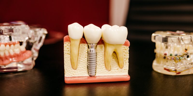 Root Canal Treatment