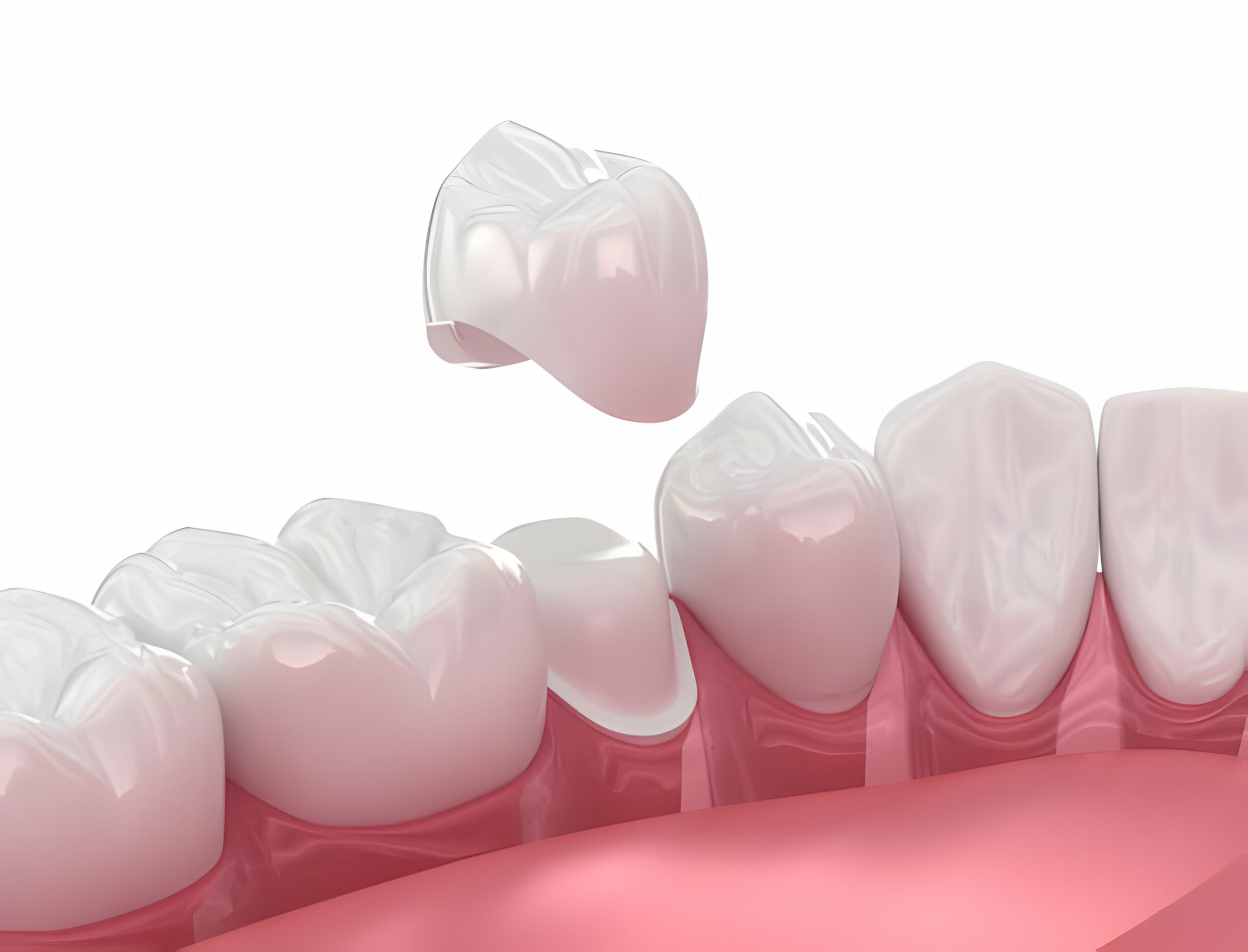Know Everything About Different Types Of Dental Crowns_1