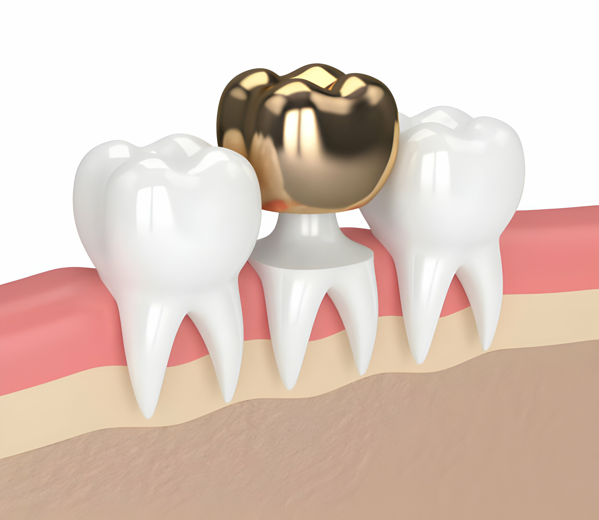 Know Everything About Different Types Of Dental Crowns_3