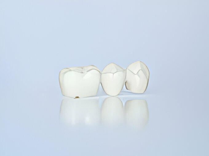 What To Expect When Getting A Dental Bridge?_3