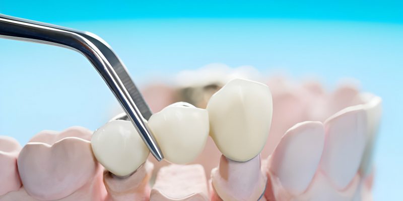 Know Everything About Different Types Of Dental Crowns_FI