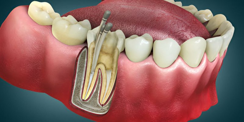 Root Canal Treatment in Farmington, NM: Why Four Corners Family Dentistry Is Your Best Choice_FI
